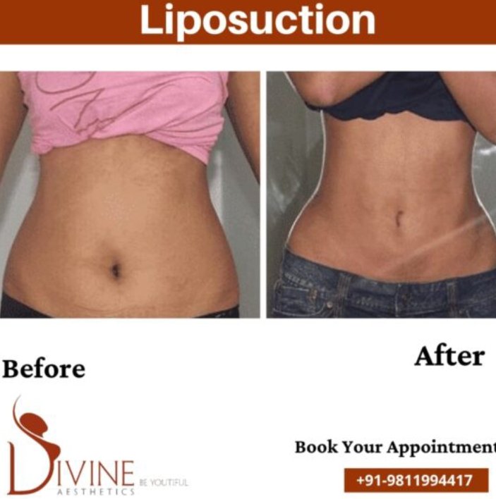 Abdominal VASER Liposuction Vs Traditional Liposuction