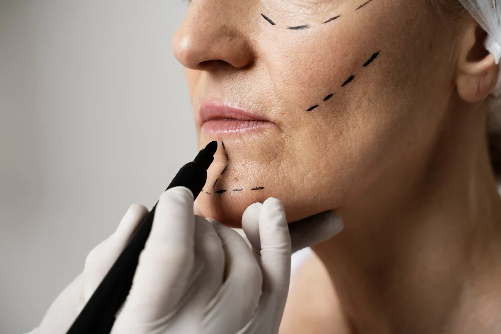 Facelift Surgery