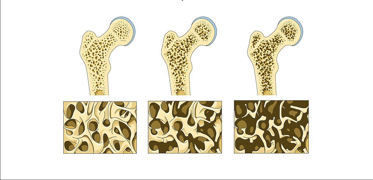 Osteopur